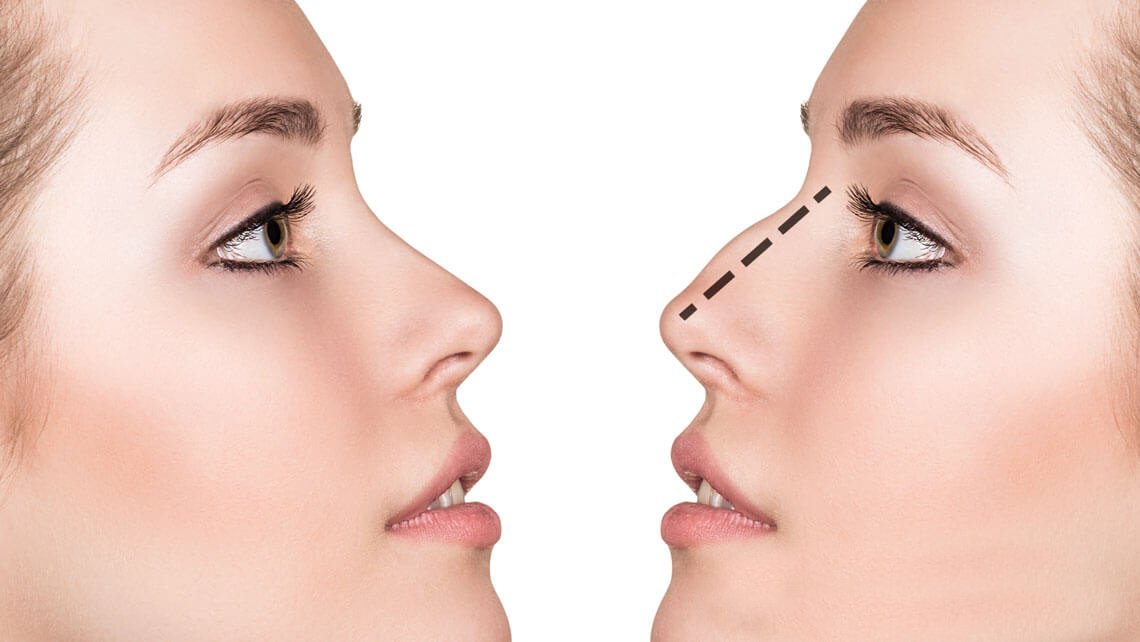 Rhinoplasty treatment